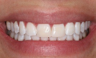 teeth whitening with front tooth veneers