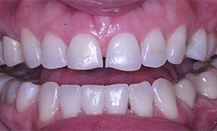 Top teeth with gap and odd shaping
