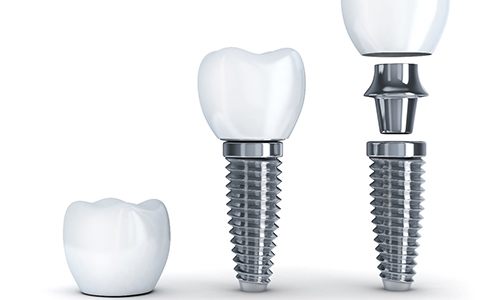 3D illustration of crown, implant, and abutment