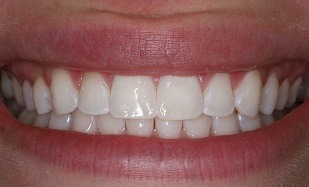 perfect teeth whitening