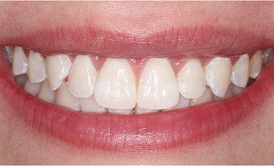 closeup of beautiful smile after whitening