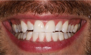 closeup Zoom Whitening results