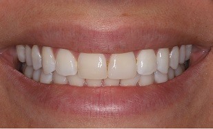 teeth whitening with veneers