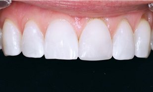 bonded teeth whitening