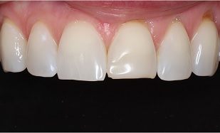 bonded teeth whitening closeup