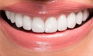 Closeup of perfected top teeth