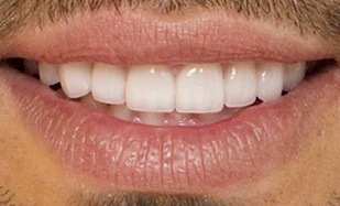 Closeup teeth whitening with veneers