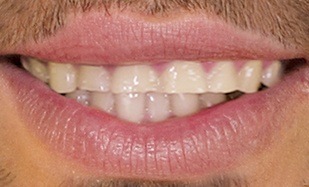 Closeup of short stubby teeth