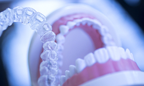 A clear Invisalign aligner in the foreground while a dental mouth mold sits open in the background
