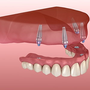 digital illustration of implant dentures in Vienna