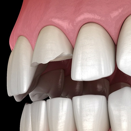 computer model of a broken tooth