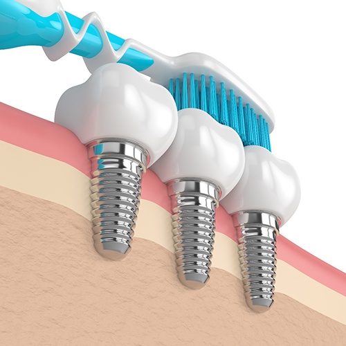 Image for dental implant care in Tysons. 