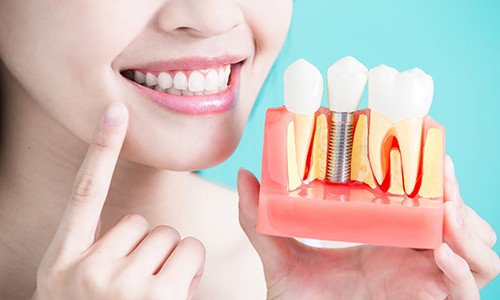 Dentist holding a dental implant model. 