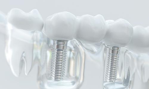 Model of an implant-retained bridge.