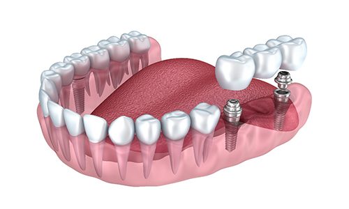 Digital model of an implant-supported bridge.