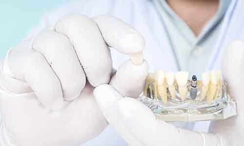 a dentist showing how a restoration attaches to a dental implant