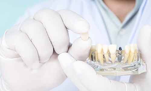 dental implant inserted into jawbone