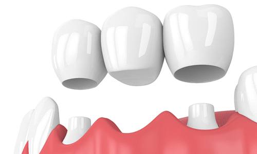 Dental implants and bridge