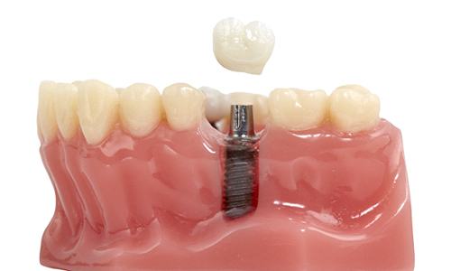 Dental implant model