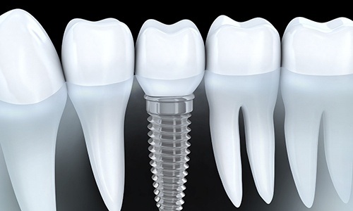 Animation of implant supported crown