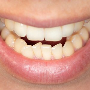a person with crowded teeth