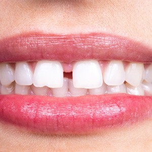 a person with a gap between their front teeth