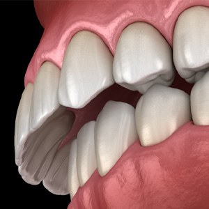 a computer illustration of an overbite