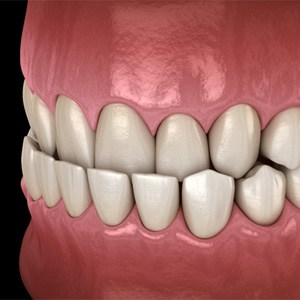 a computer illustration of an underbite