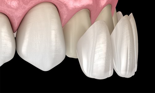 Porcelain Veneers