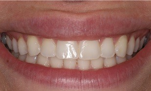 closeup of teeth whitening