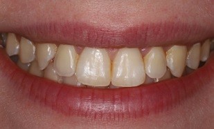 closeup of yellow teeth before teeth whitening