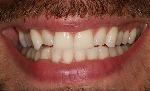 closeup of Zoom Whitening before