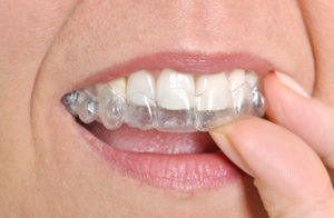 clear aligners