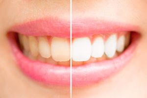 teeth whitening before and after