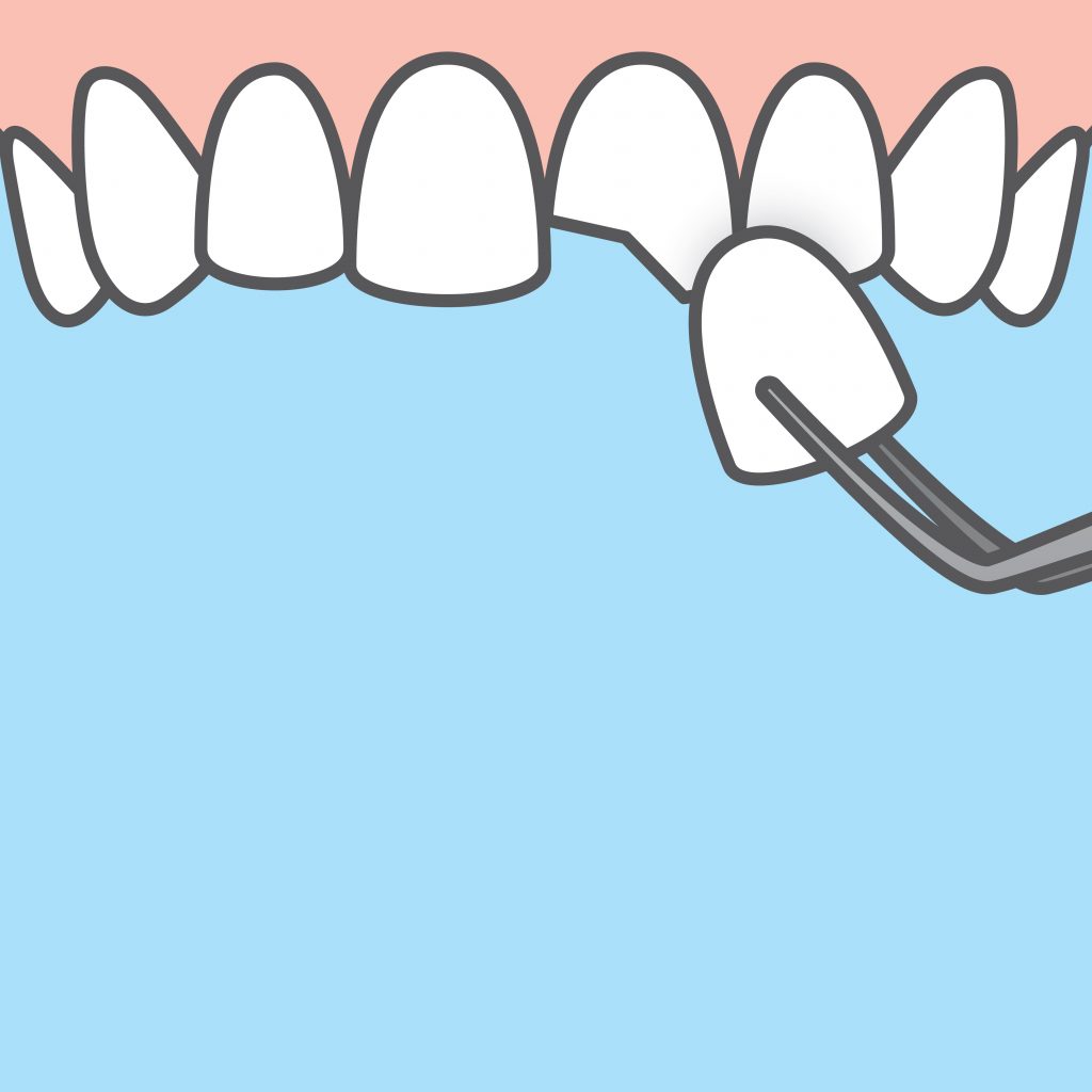 illustration of chipped dental veneers 