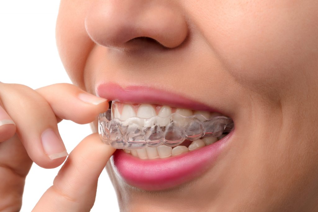 patient wearing Invisalign in Vienna during the holidays