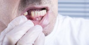 Gloved hand exposing man’s missing tooth